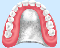 金属床義歯