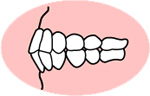 上下顎前突（じょうげがくぜんとつ）
