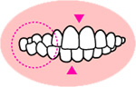 交叉咬合（こうさこうごう）