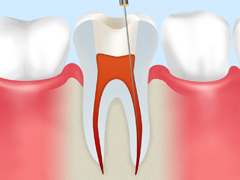 1.むし歯菌に冒された歯の神経や血管を取り除きます